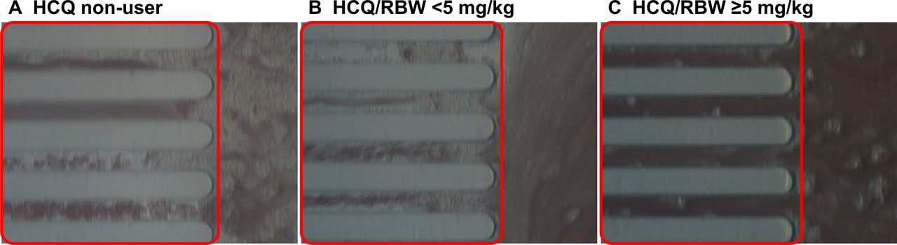 Antiplatelet effects of hydroxychloroquine in patients with systemic ...